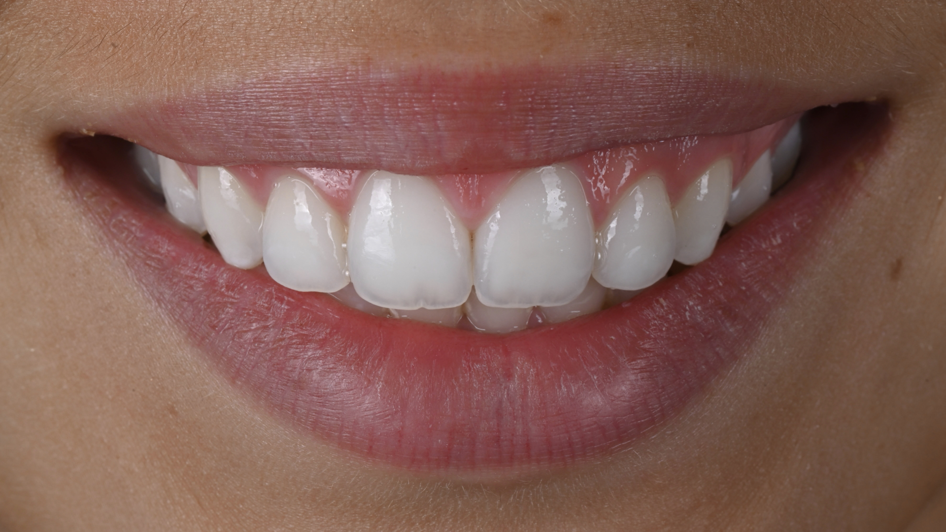 Natural smile after esthetic treatment